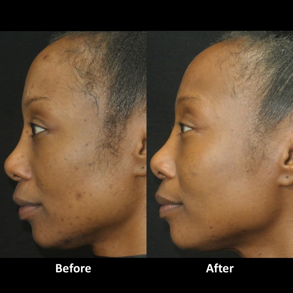Micro Laser Peel before and after